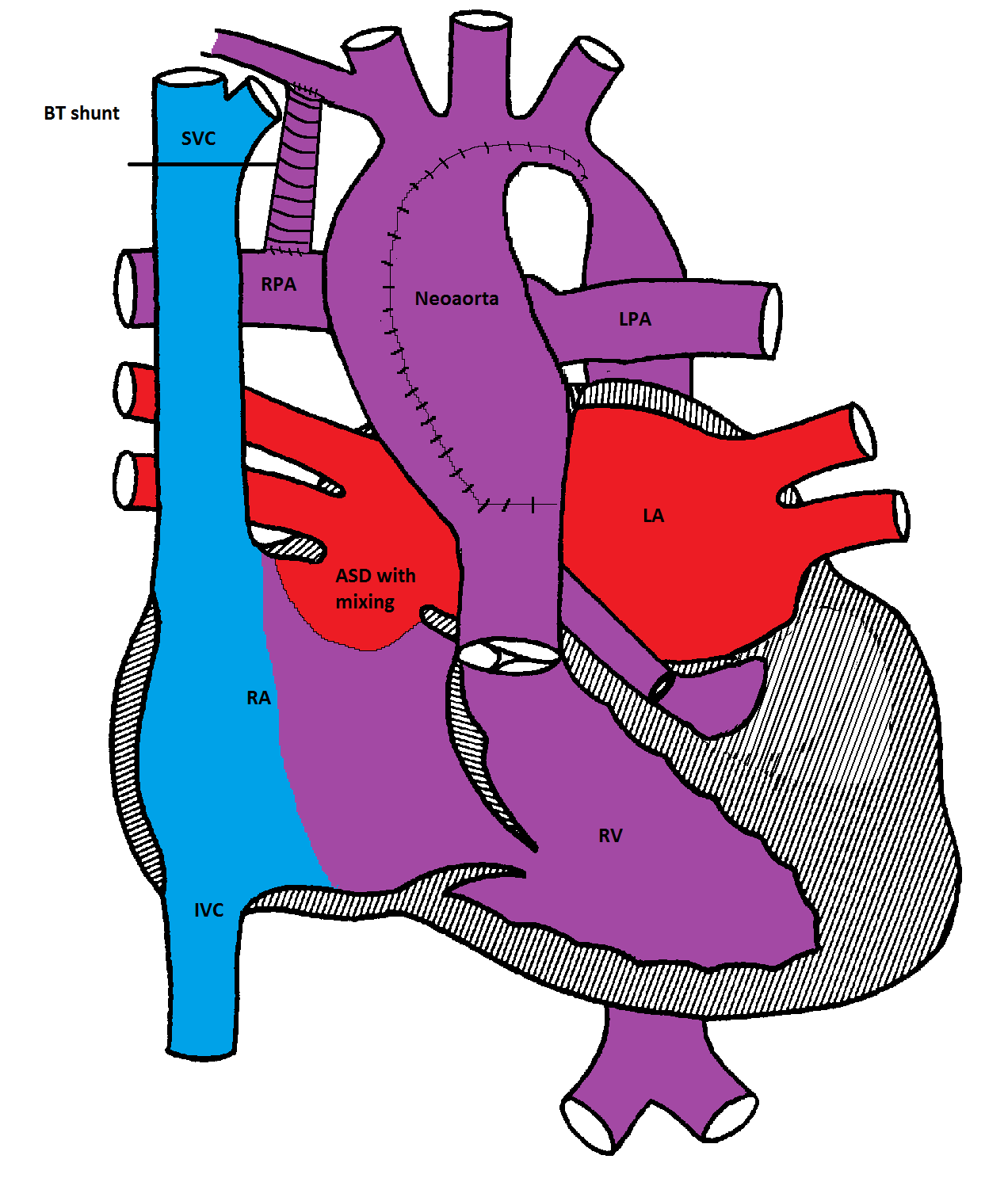 Norwood procedure